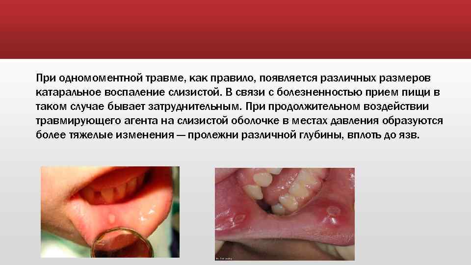 При одномоментной травме, как правило, появляется различных размеров катаральное воспаление слизистой. В связи с