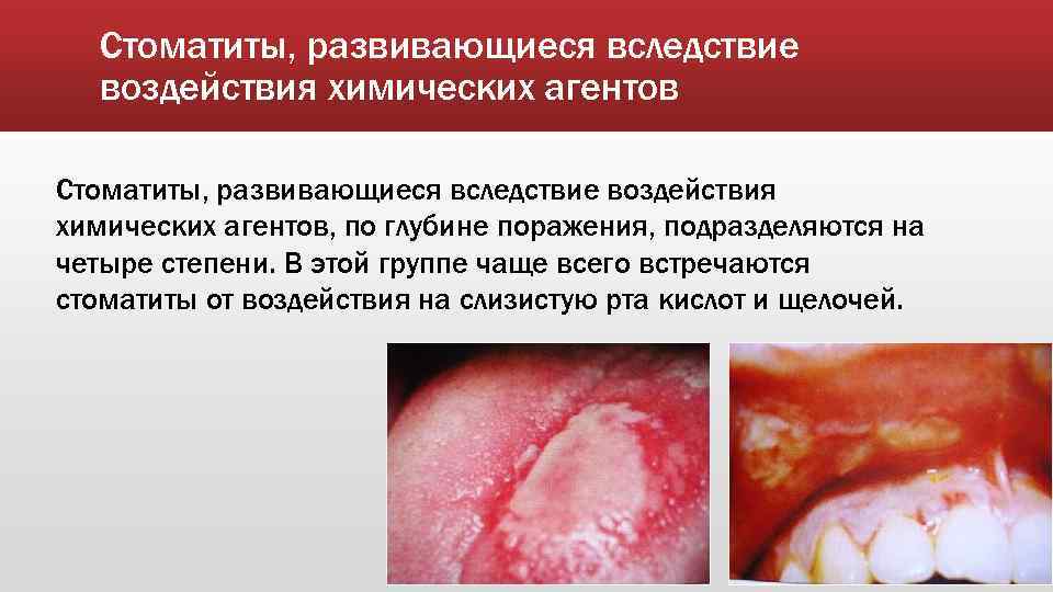 Стоматиты, развивающиеся вследствие воздействия химических агентов, по глубине поражения, подразделяются на четыре степени. В