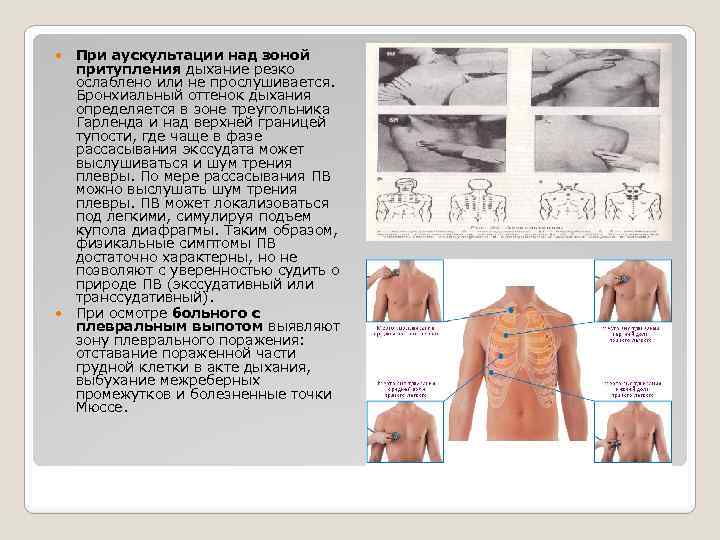  При аускультации над зоной притупления дыхание резко ослаблено или не прослушивается. Бронхиальный оттенок