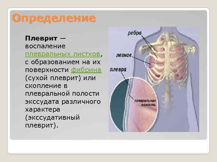 Определение Плеврит — воспаление плевральных листков, с образованием на их поверхности фибрина (сухой плеврит)