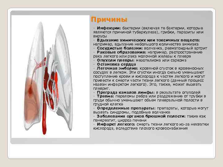 Причины · Инфекции: бактерии (включая те бактерии, которые являются причиной туберкулеза), грибки, паразиты или