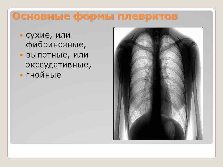 Основные формы плевритов сухие, или фибринозные, выпотные, или экссудативные, гнойные 
