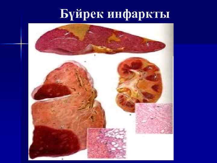 Бүйрек инфаркты 