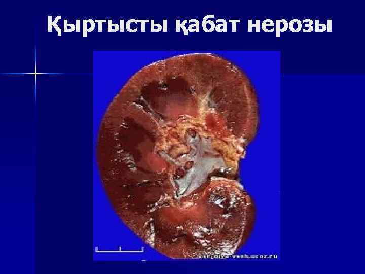 Қыртысты қабат нерозы 