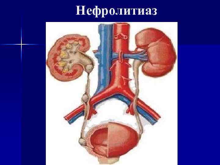 Нефролитиаз. Нефролитиаз заболевание почек.