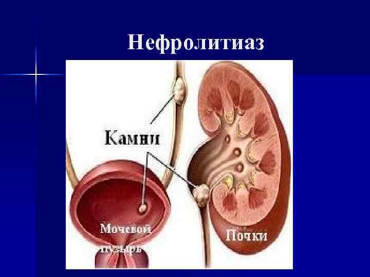 Нефролитиаз это. Нефролитиаз почек что это такое симптомы. Почечнокаменная болезнь (нефролитиаз). Нефролитиаз обеих почек. Левосторонний нефролитиаз.