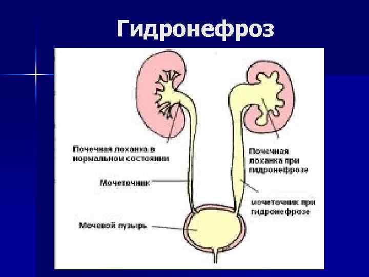 Гидронефроз 