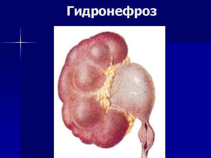 Гидронефроз 