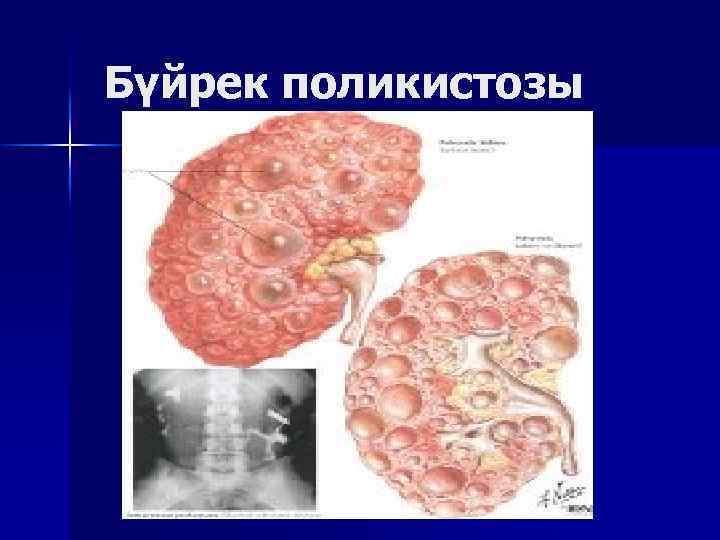 Бүйрек поликистозы 