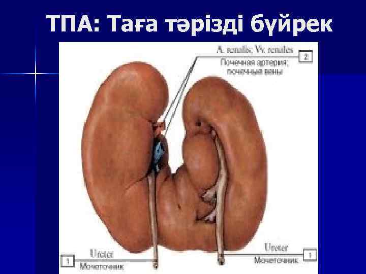 ТПА: Таға тәрізді бүйрек 
