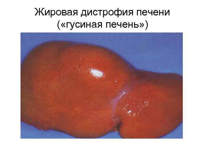 Жировая дистрофия печени ( «гусиная печень» ) 