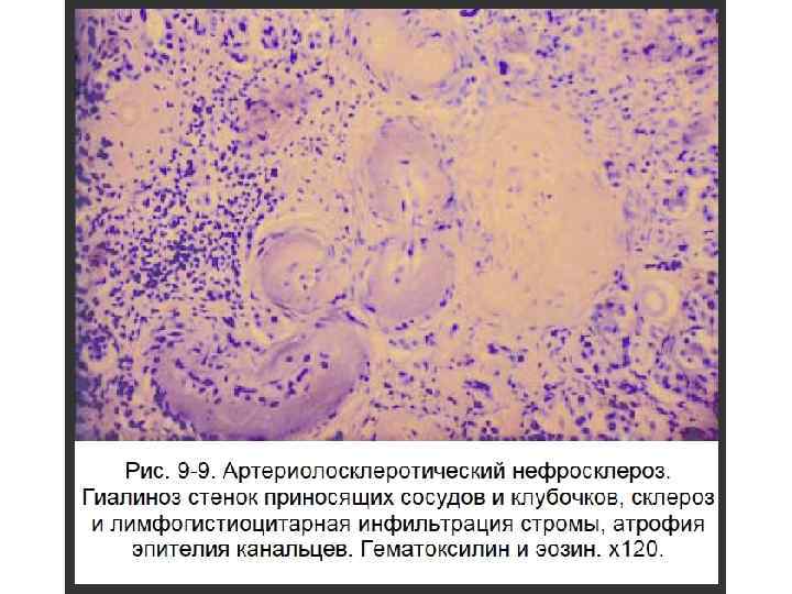 Артериолосклеротический нефросклероз микропрепарат рисунок