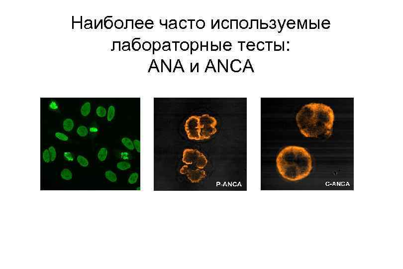 Наиболее часто используемые лабораторные тесты: ANA и ANCA 