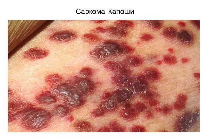 Саркома Капоши 