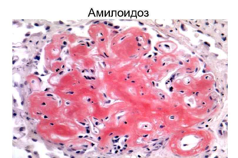 Амилоидоз 