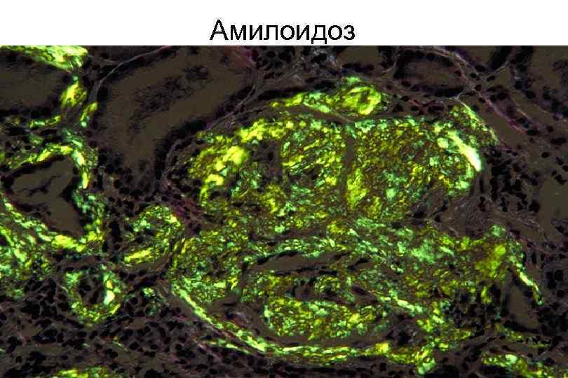 Амилоидоз 