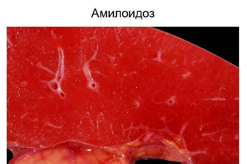 Амилоидоз 