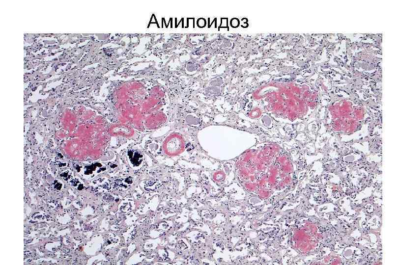 Амилоидоз 