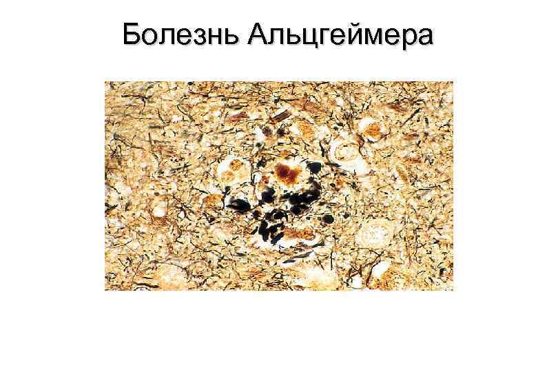 Болезнь Альцгеймера 