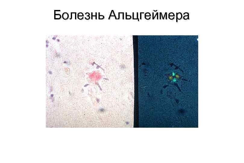 Болезнь Альцгеймера 