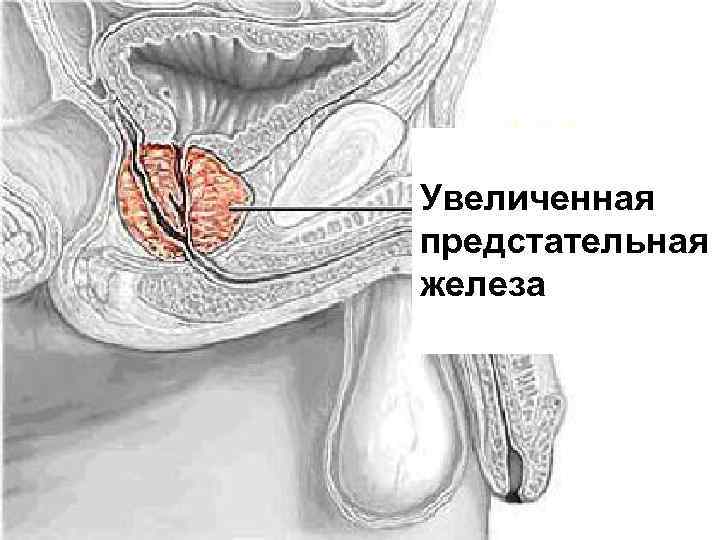 Увеличенная предстательная железа 