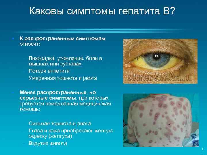 Каковы симптомы гепатита В? • К распространенным симптомам относят: – Лихорадка, утомление, боли в