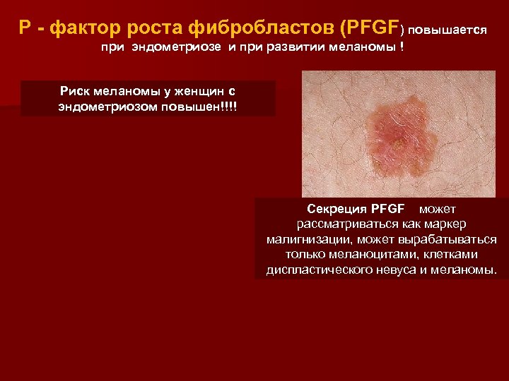 Р - фактор роста фибробластов (PFGF) повышается при эндометриозе и при развитии меланомы !