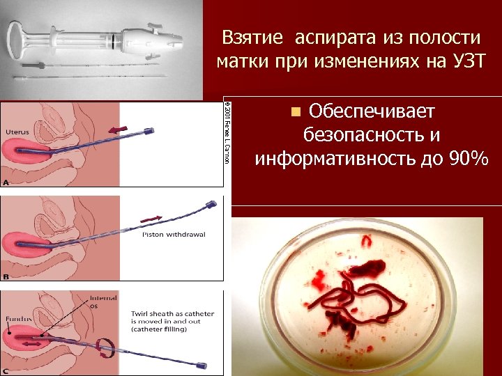 Взятие аспирата из полости матки при изменениях на УЗТ Обеспечивает безопасность и информативность до