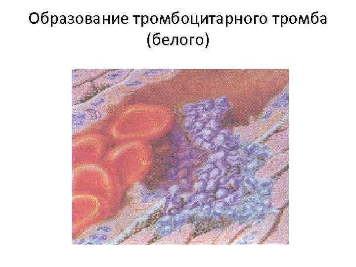 Схема образования тромбоцитарного тромба