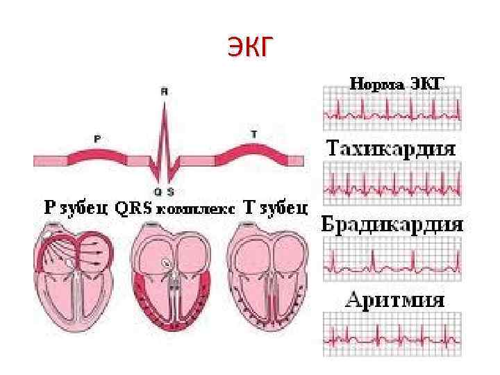 ЭКГ 