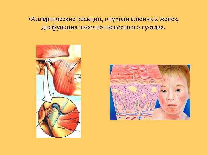  • Аллергические реакции, опухоли слюнных желез, дисфункция височно-челюстного сустава. 