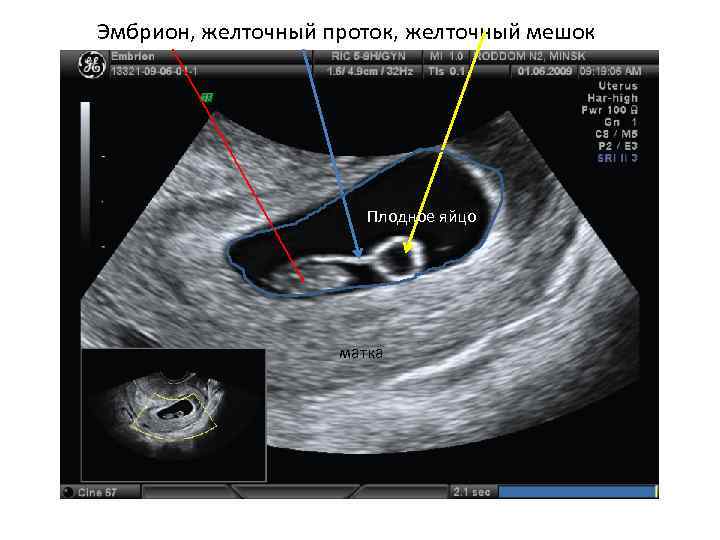 Эмбрион, желточный проток, желточный мешок Плодное яйцо матка 