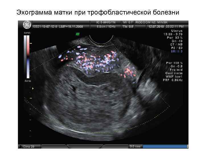 Эхограмма матки при трофобластической болезни 