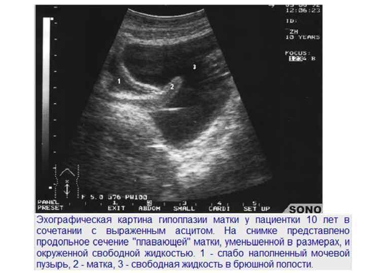 Матка меньше. Гипоплазия матки на УЗИ. Симптом плавающей матки. Свободная жидкость за мочевым пузырем.