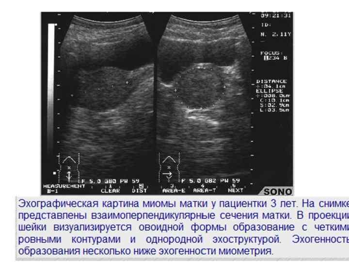 Узи картина миомы матки