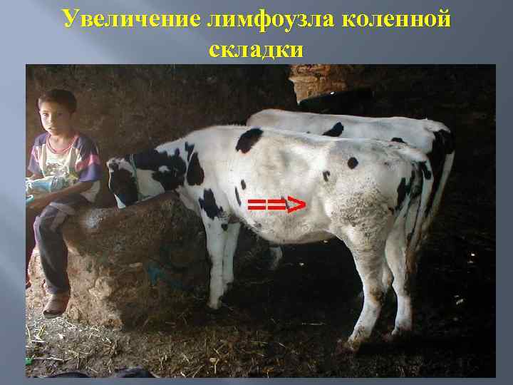 Увеличение лимфоузла коленной складки 