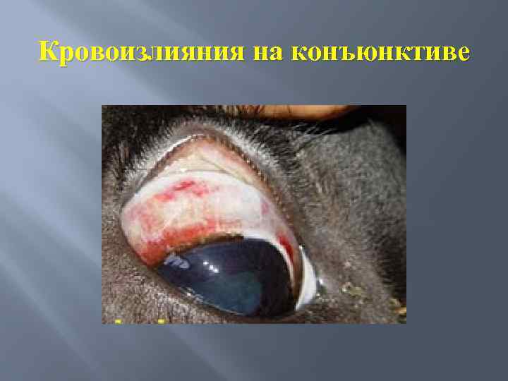 Кровоизлияния на конъюнктиве 