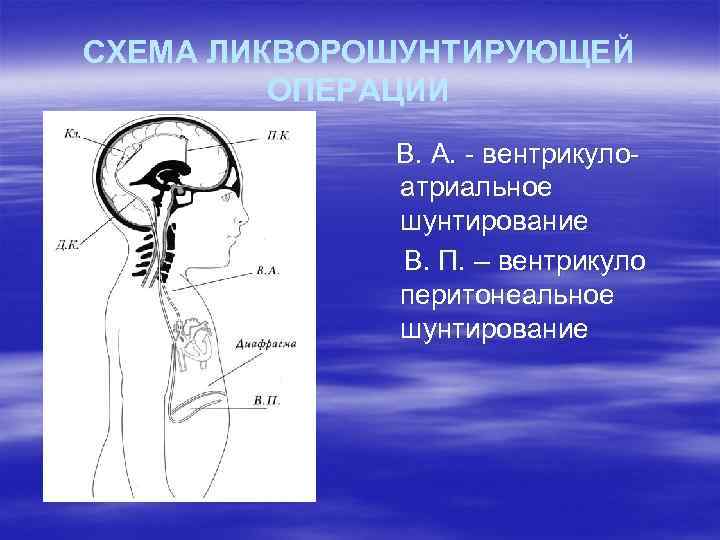 СХЕМА ЛИКВОРОШУНТИРУЮЩЕЙ ОПЕРАЦИИ В. А. - вентрикулоатриальное шунтирование В. П. – вентрикуло перитонеальное шунтирование