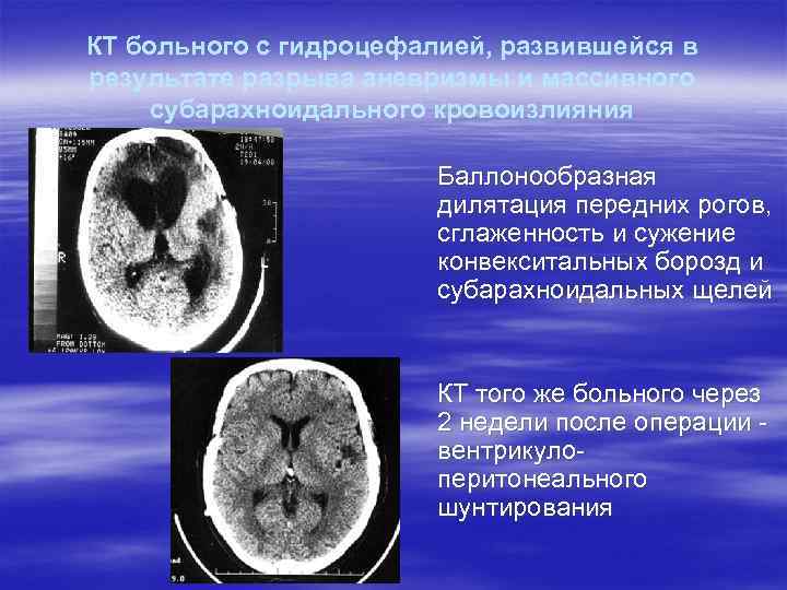 КТ больного с гидроцефалией, развившейся в результате разрыва аневризмы и массивного субарахноидального кровоизлияния Баллонообразная