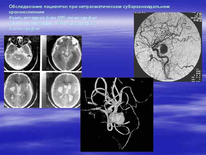 Обследование пациентов при нетравматическом субарахноидальном кровоизлиянии Компьютерная (или МР) томография 3 D КТ-ангиография, МР-ангиография