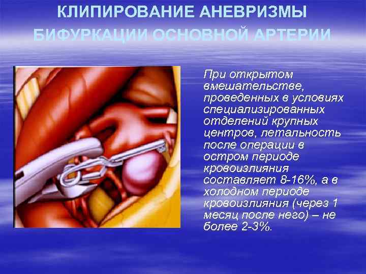 КЛИПИРОВАНИЕ АНЕВРИЗМЫ БИФУРКАЦИИ ОСНОВНОЙ АРТЕРИИ При открытом вмешательстве, проведенных в условиях специализированных отделений крупных