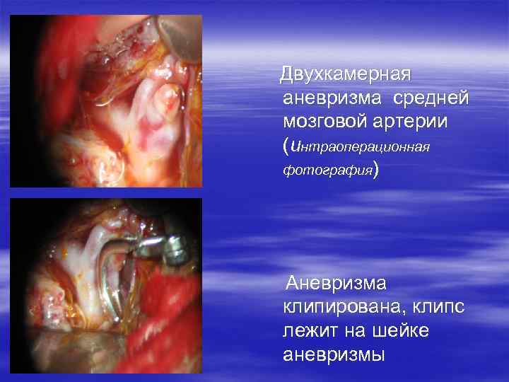 Двухкамерная аневризма средней мозговой артерии (интраоперационная фотография) Аневризма клипирована, клипс лежит на шейке аневризмы