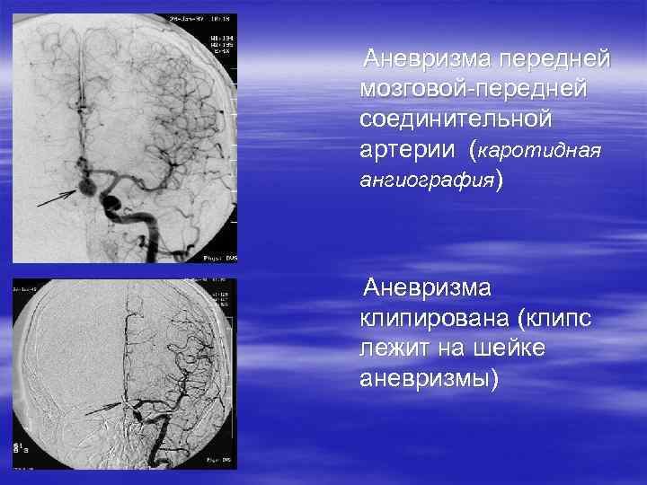 Аневризма передней мозговой-передней соединительной артерии (каротидная ангиография) Аневризма клипирована (клипс лежит на шейке аневризмы)