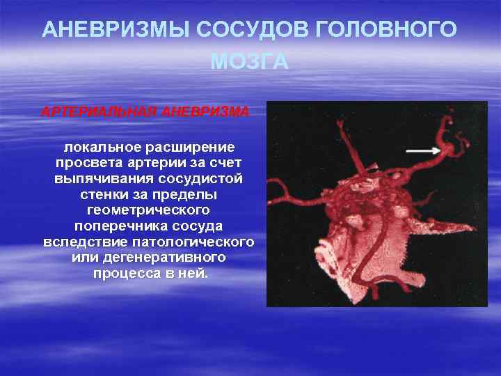 АНЕВРИЗМЫ СОСУДОВ ГОЛОВНОГО МОЗГА АРТЕРИАЛЬНАЯ АНЕВРИЗМА локальное расширение просвета артерии за счет выпячивания сосудистой