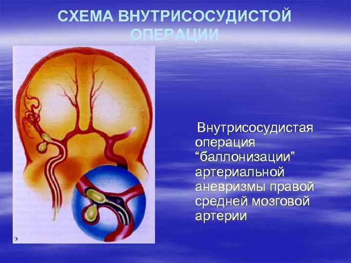 СХЕМА ВНУТРИСОСУДИСТОЙ ОПЕРАЦИИ Внутрисосудистая операция “баллонизации” артериальной аневризмы правой средней мозговой артерии 
