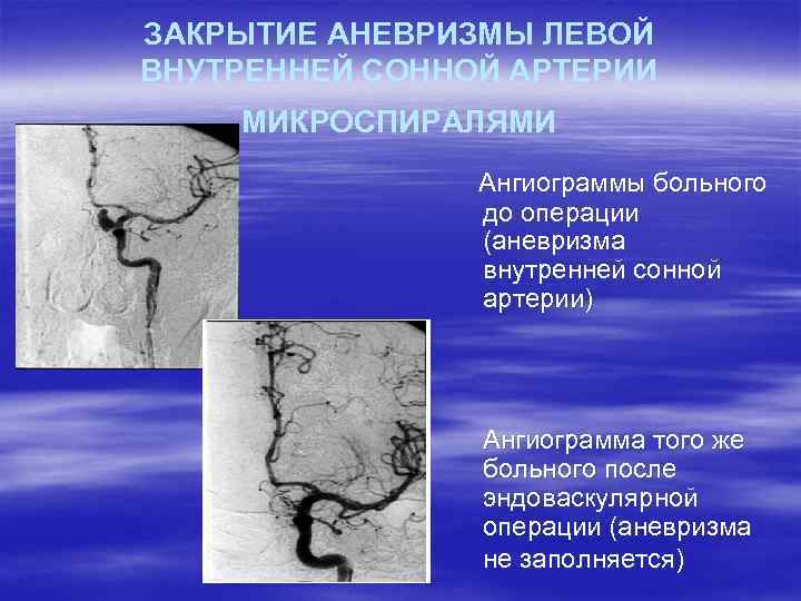 ЗАКРЫТИЕ АНЕВРИЗМЫ ЛЕВОЙ ВНУТРЕННЕЙ СОННОЙ АРТЕРИИ МИКРОСПИРАЛЯМИ Ангиограммы больного до операции (аневризма внутренней сонной