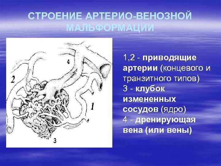 СТРОЕНИЕ АРТЕРИО-ВЕНОЗНОЙ МАЛЬФОРМАЦИИ 1, 2 - приводящие артерии (концевого и транзитного типов) 3 -