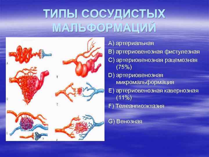 ТИПЫ СОСУДИСТЫХ МАЛЬФОРМАЦИЙ А) артериальная В) артериовенозная фистулезная С) артериовенозная рацемозная (75%) D) артериовенозная