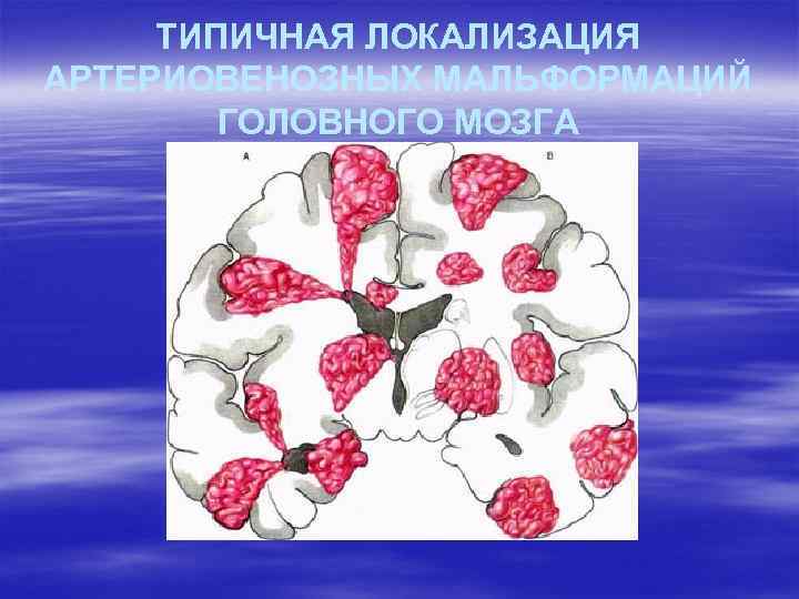 ТИПИЧНАЯ ЛОКАЛИЗАЦИЯ АРТЕРИОВЕНОЗНЫХ МАЛЬФОРМАЦИЙ ГОЛОВНОГО МОЗГА 