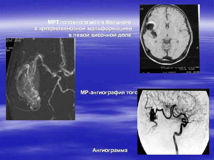  МРТ головного мозга больного с артериовенозной мальформацией в левой височной доле МР-ангиография того-